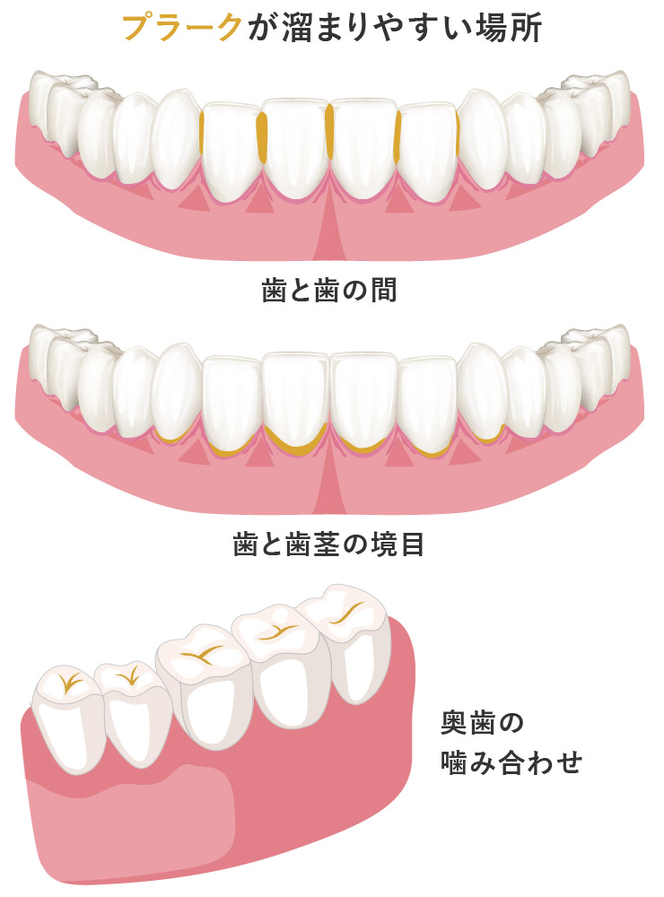 まさか歯ブラシだけで済ませてない 正しいオーラルケアで歯周病を防ぐ